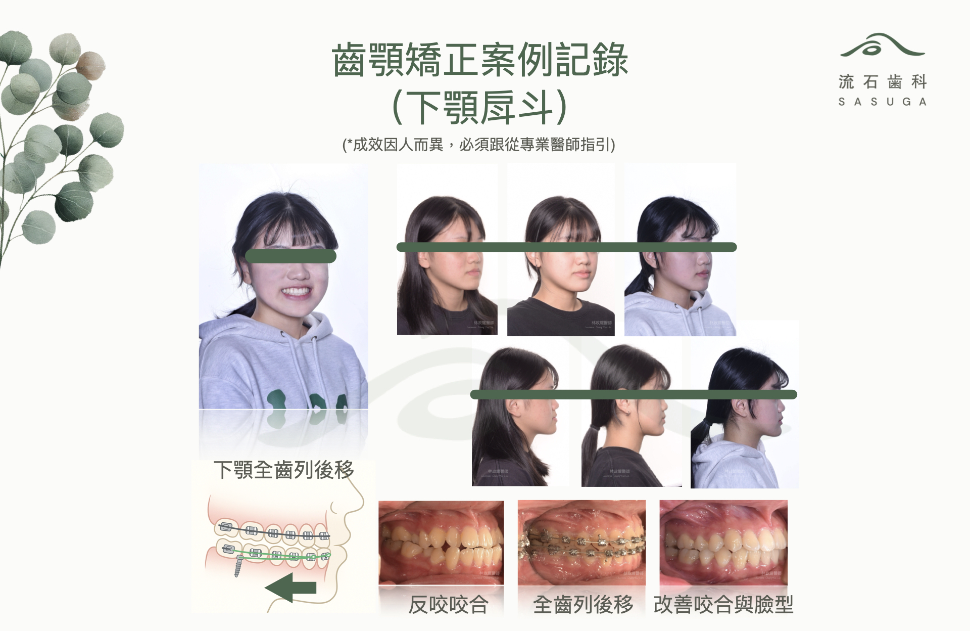 齒顎矯正戽斗案例 外觀改善