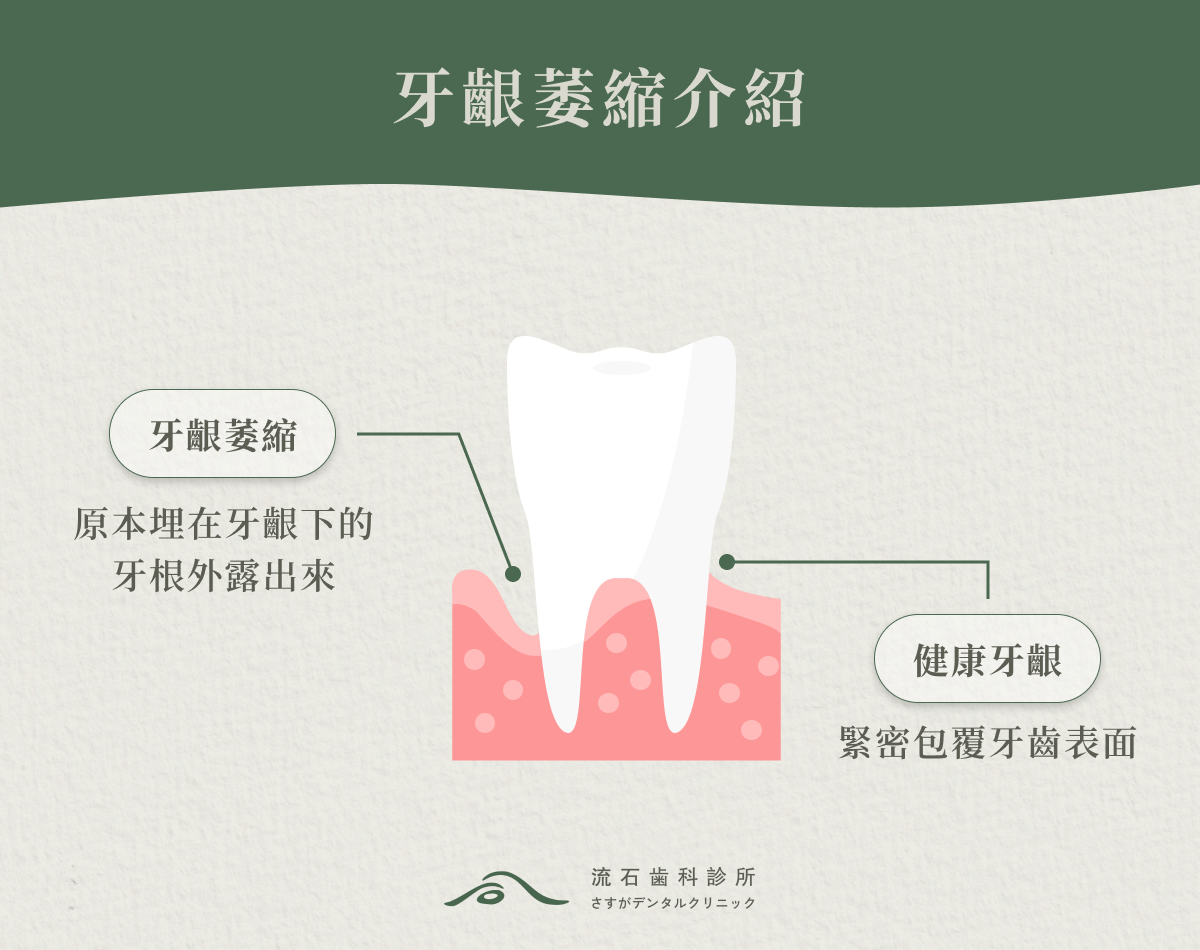 牙齦萎縮介紹