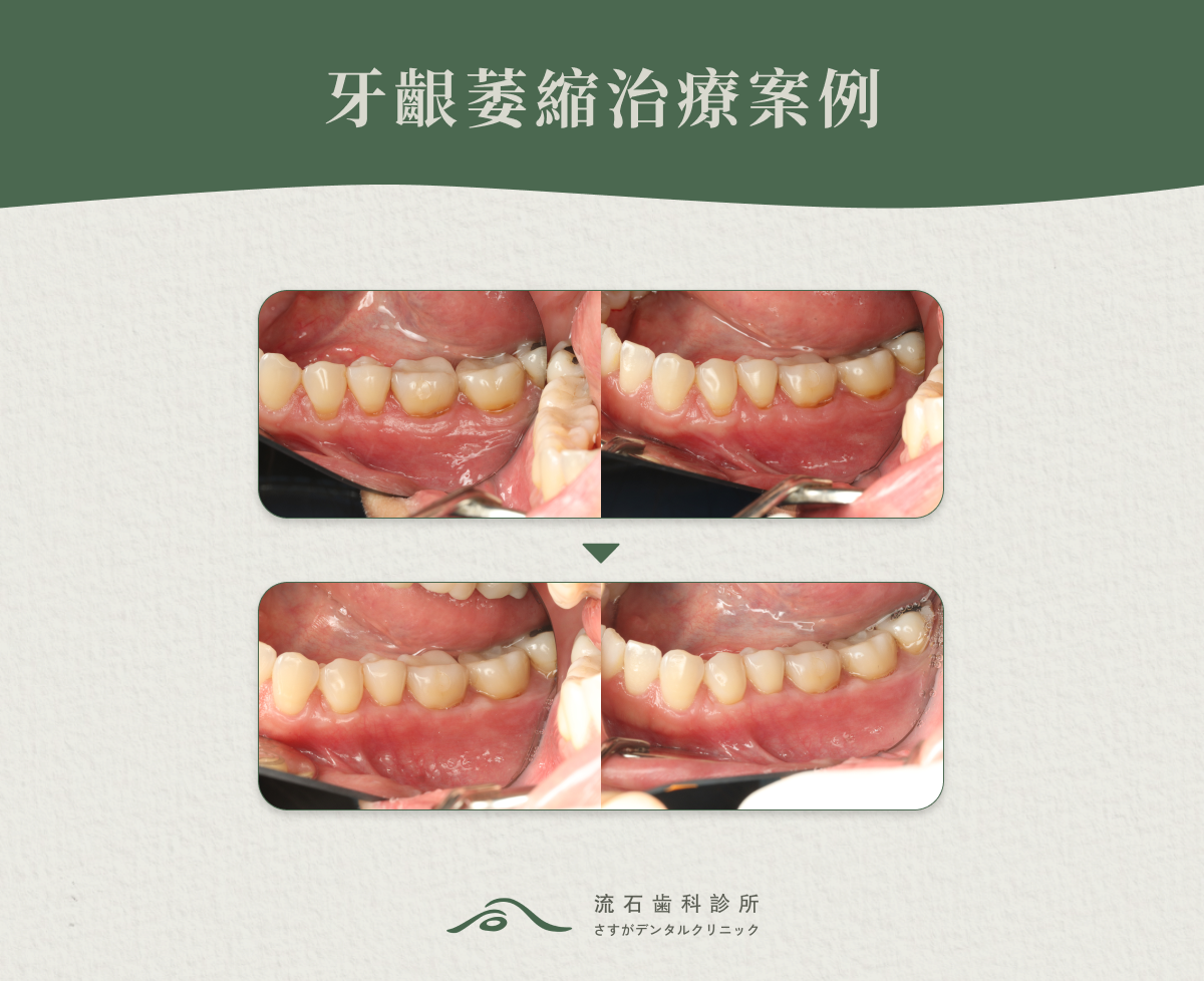 牙齦萎縮治療案例
