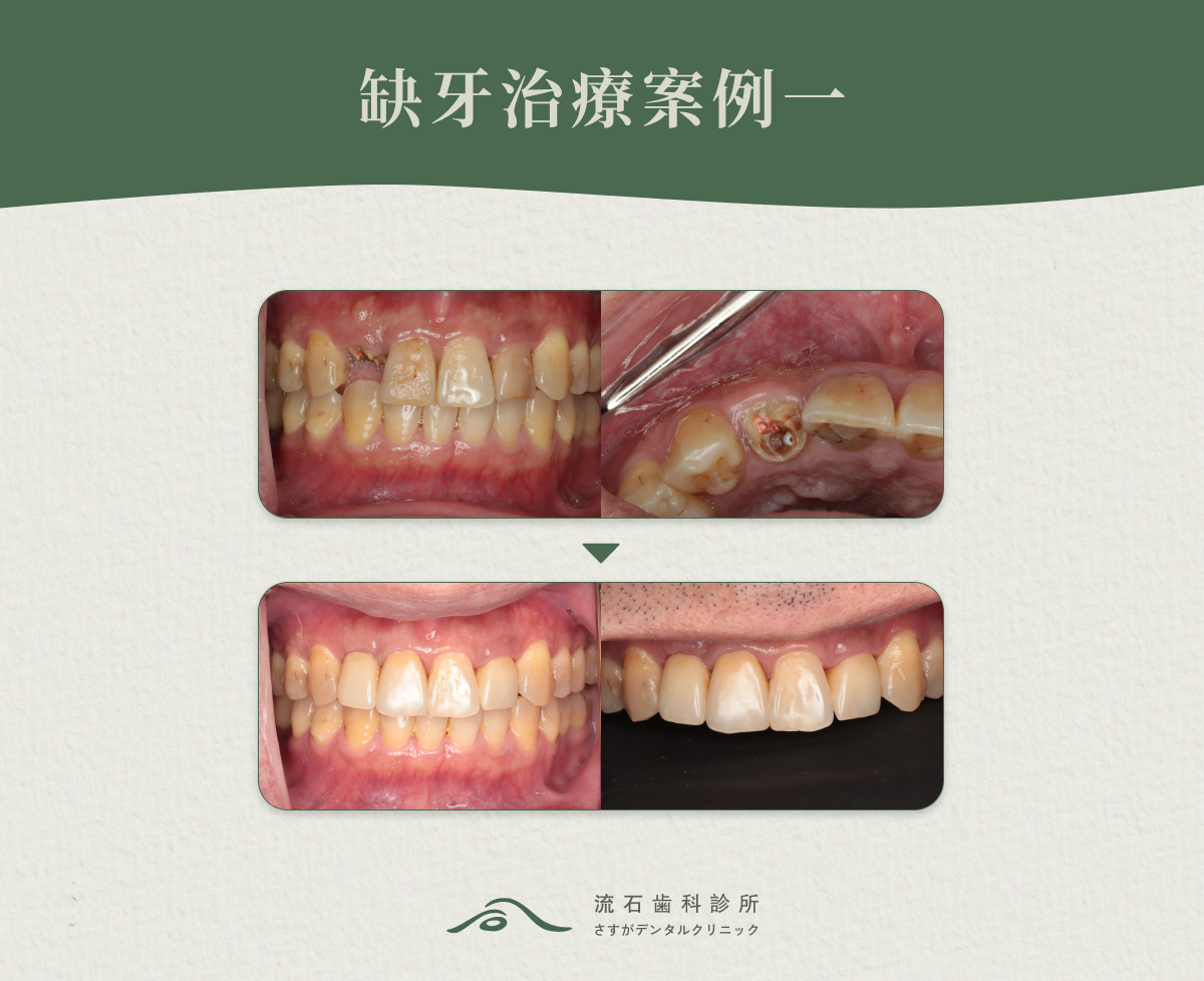 缺牙治療案例一