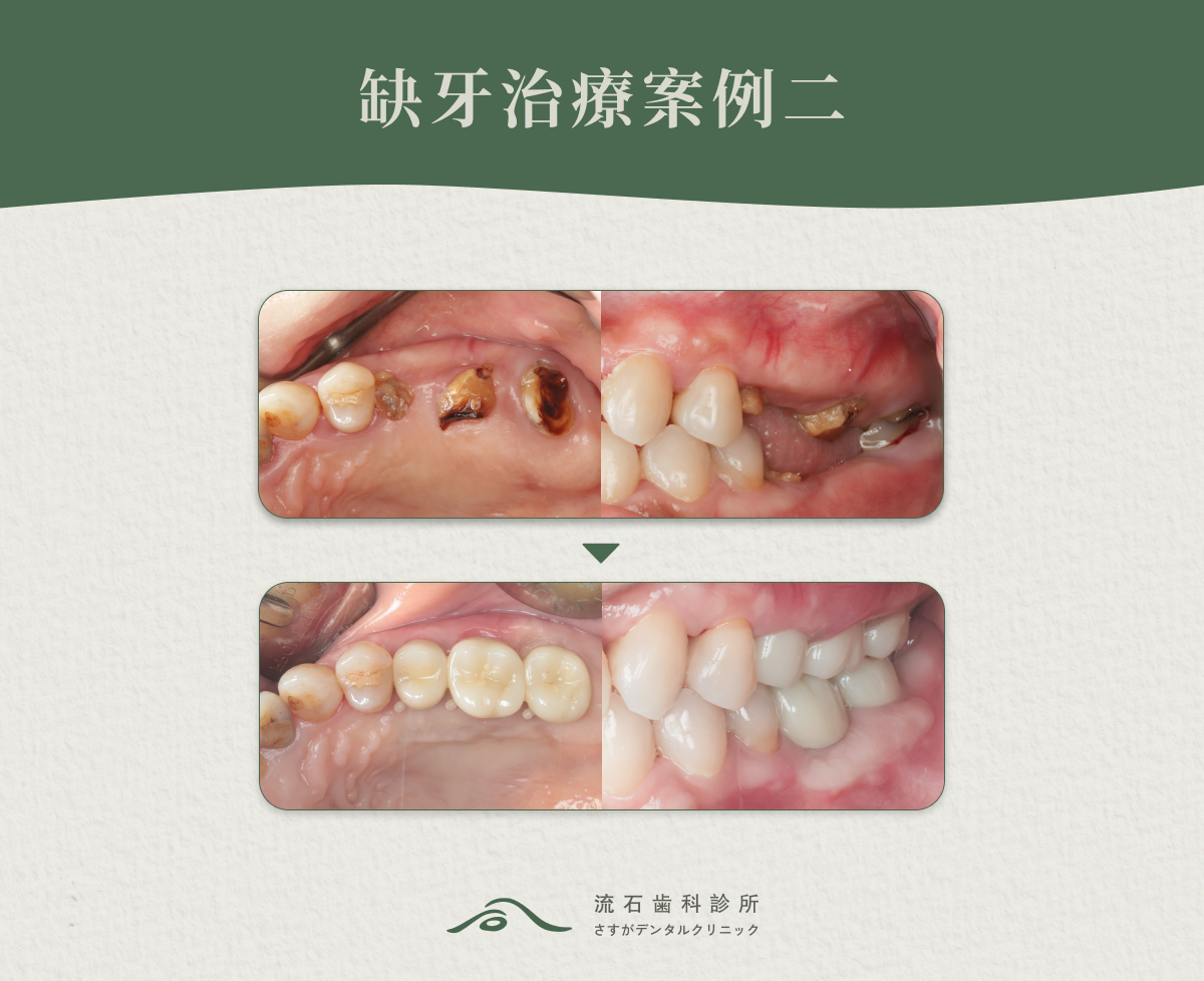 缺牙治療案例二