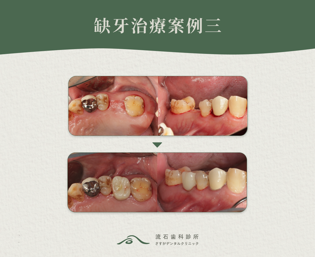 缺牙治療案例三