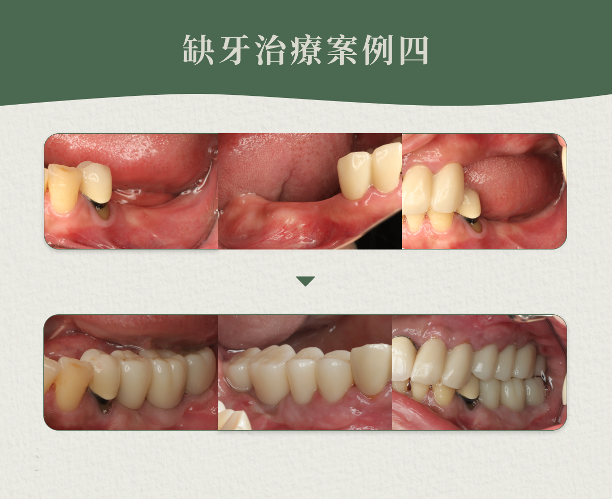 缺牙治療案例四